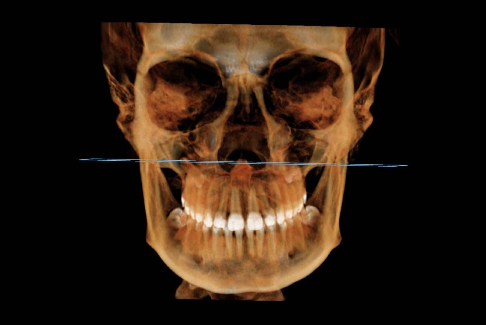 CBCT-bimaxilar-ATM-scaled