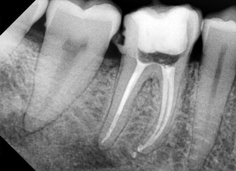 radiografia-digitala-retroalveolara-1-820x594px